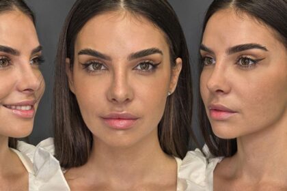 mellina si a operat nasul artista e super fericita la zece zile de la interventia estetica de rinoplastie mi am facut toate mofturile sufletului meu anul asta 68e4ebf308445