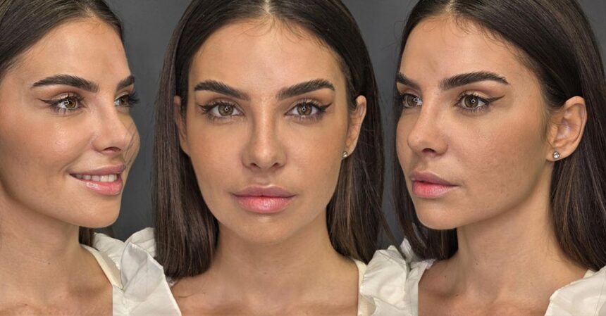 mellina si a operat nasul artista e super fericita la zece zile de la interventia estetica de rinoplastie mi am facut toate mofturile sufletului meu anul asta 68e4ebf308445